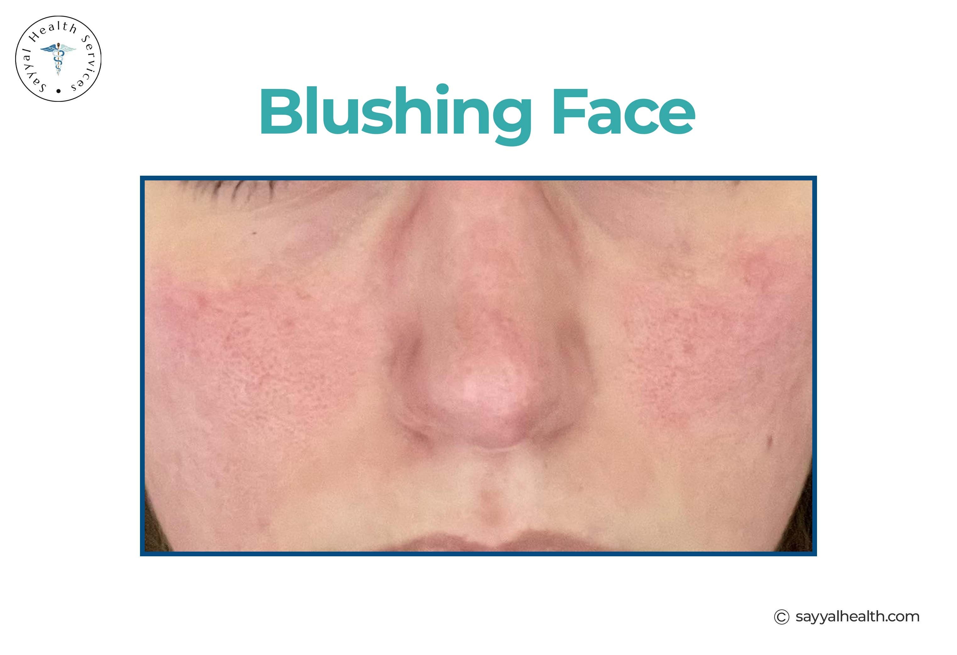 Blushing and redness on facial cheeks and neck